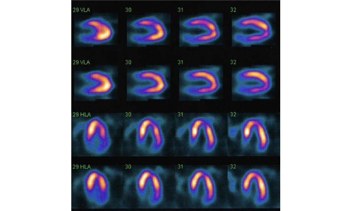 Myocardial perfusion scan
