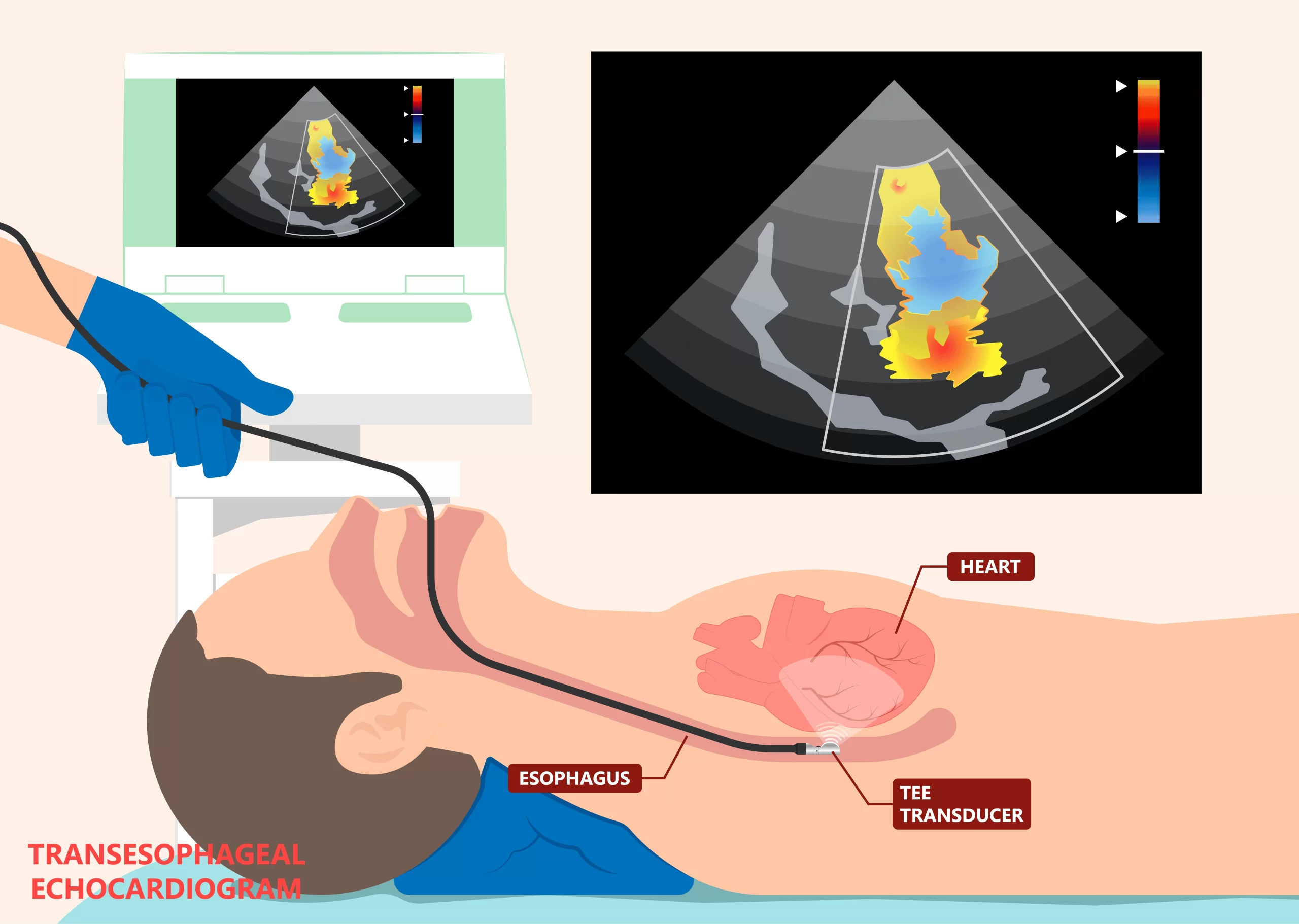 Transesophageal echochardiography.