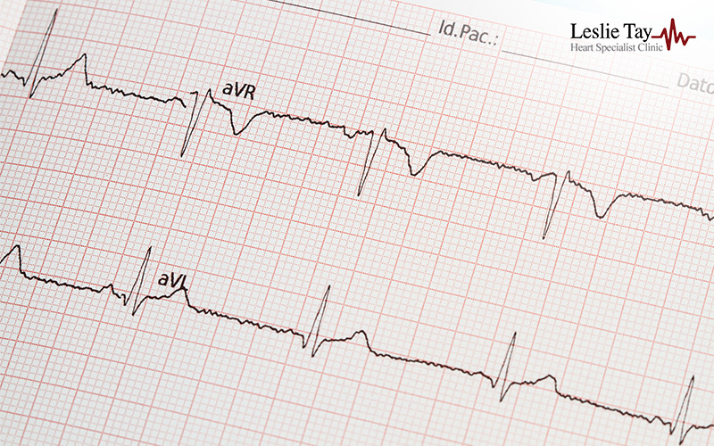 ECG printout showing heart waveforms labeled aVR and aVL, used in cardiac diagnostics at specialist clinic.