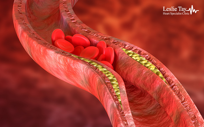 Illustration of plaque buildup causing blocked arteries and atherosclerosis.
